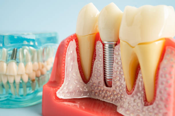 Best Root Canal Treatment  in Geneva, FL